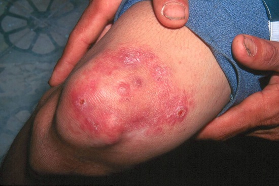 fotos de lepra (13)_thumb[1].jpg